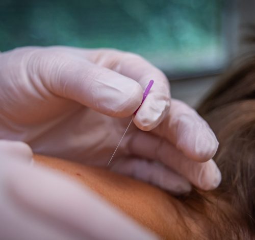 Dry Needling behandeling